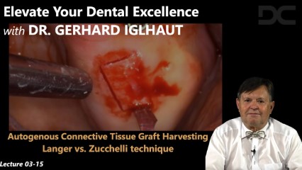 Autogenous connective tissue graft harvesting: Langer vs. Zucchelli technique